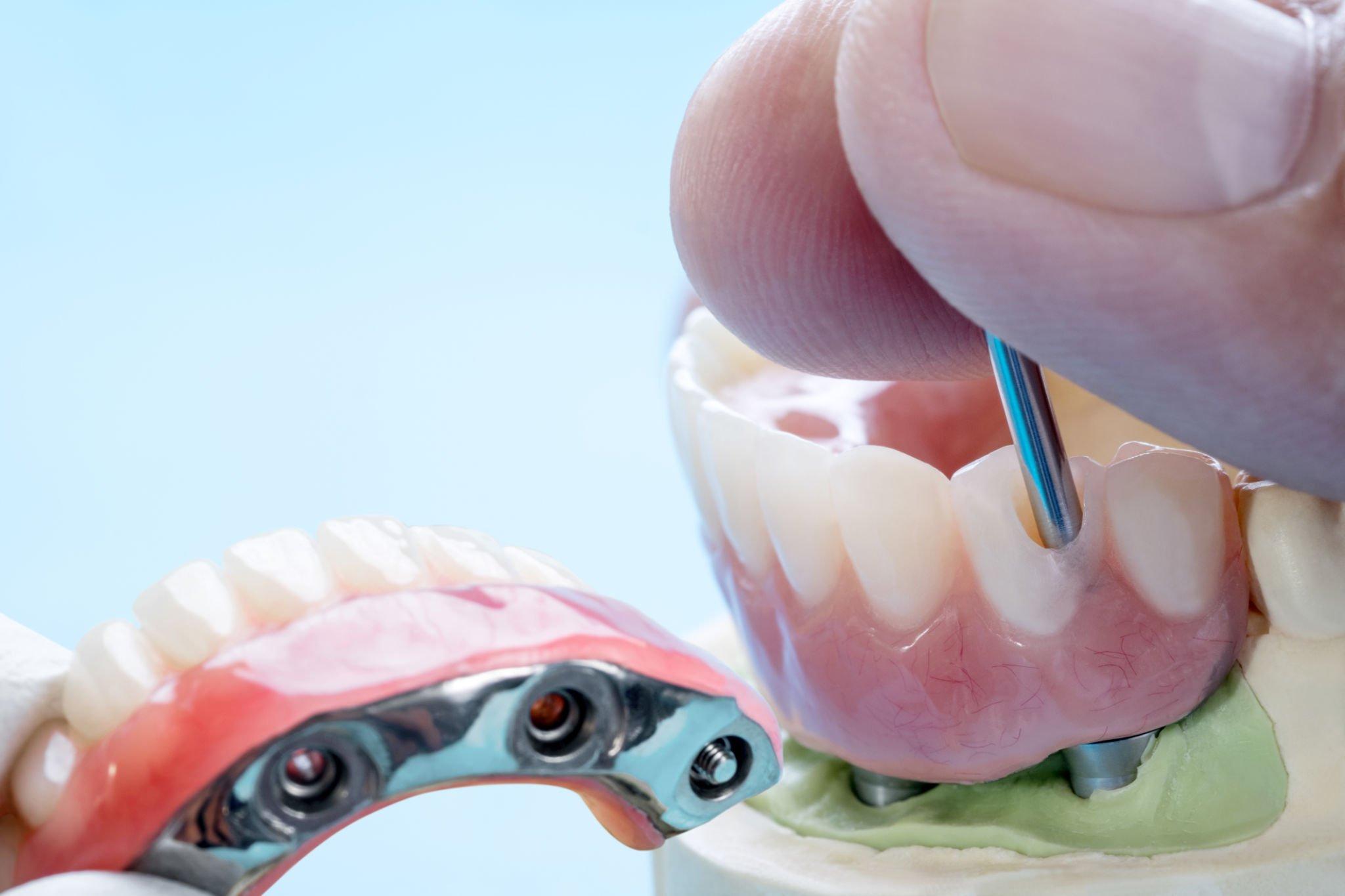 Potential Drawbacks of Traditional Dentures